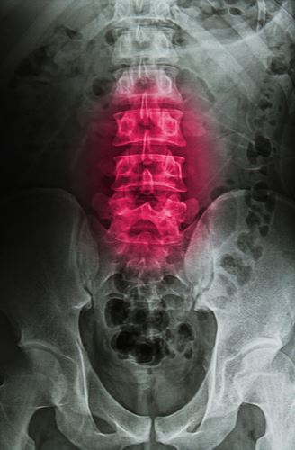 spinal cord injury